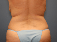 Tummy Tuck