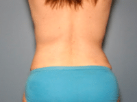 Tummy Tuck