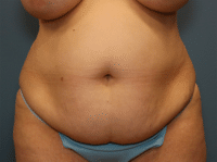 Tummy Tuck