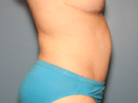 Tummy Tuck