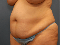 Tummy Tuck