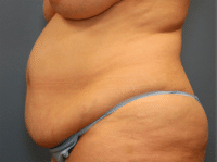 Tummy Tuck