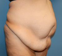 Panniculectomy