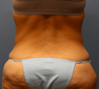 Tummy Tuck