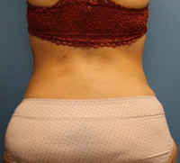 Tummy Tuck