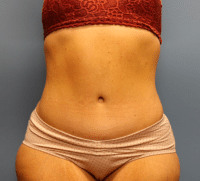 Tummy Tuck