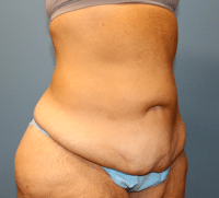 Tummy Tuck