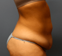 Tummy Tuck