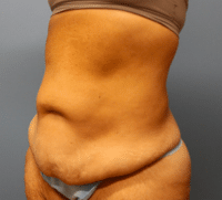 Tummy Tuck