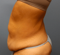 Tummy Tuck