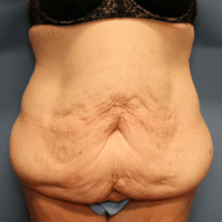 Before and after lateral view Panniculectomy - Sadove Cosmetic Surgery