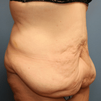 Before and after lateral view Panniculectomy - Sadove Cosmetic Surgery