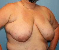 Breast Reduction