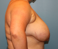 Breast Reduction