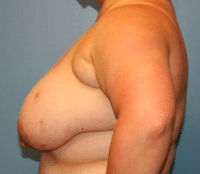 Breast Reduction