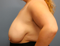 Breast Reduction