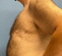 Gynecomastia Surgery