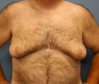 Gynecomastia Surgery