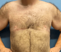 Gynecomastia Surgery