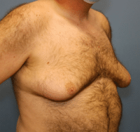 Gynecomastia Surgery