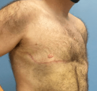 Gynecomastia Surgery