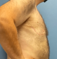 Gynecomastia Surgery