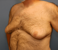 Gynecomastia Surgery