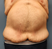 Panniculectomy