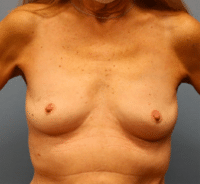 Breast Augmentation