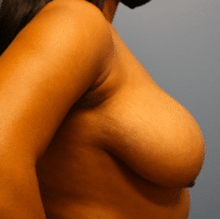 Breast Reduction