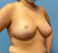 Breast Reduction