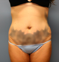 Tummy Tuck