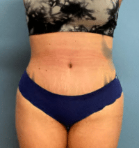 Tummy Tuck