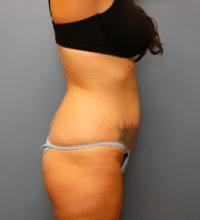 Tummy Tuck