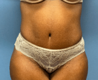 Tummy Tuck