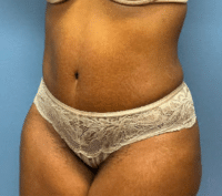 Tummy Tuck