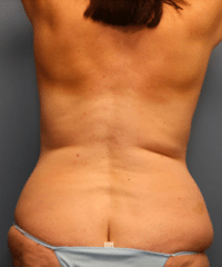 Liposuction