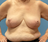 Breast Reduction