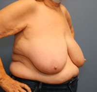 Breast Reduction