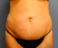 Tummy Tuck