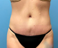 Tummy Tuck