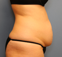 Tummy Tuck