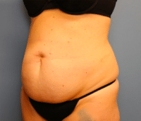 Tummy Tuck