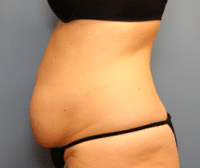 Tummy Tuck