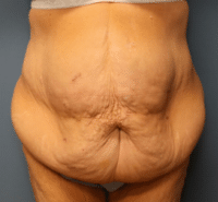 Panniculectomy