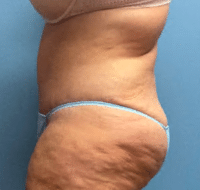 Tummy Tuck