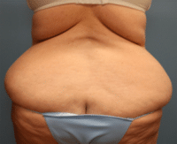 Tummy Tuck