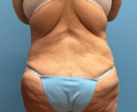 Tummy Tuck