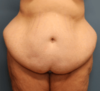 Tummy Tuck