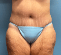 Tummy Tuck